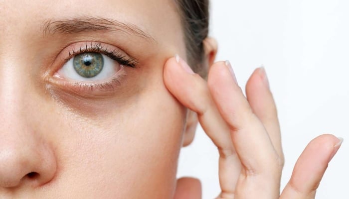 آنکھوں کے نیچے سیاہ حلقے کن امراض کا نتیجہ ہو سکتے ہیں؟