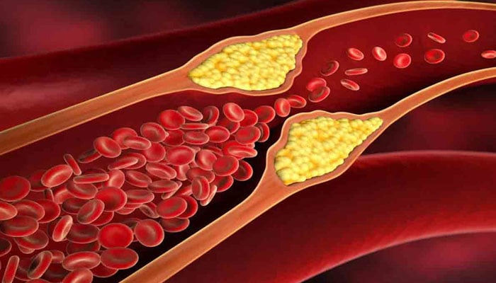 جسم میں کولیسٹرول کی سطح کو کم کرنے کے آسان طریقے