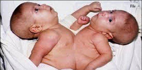 ملتان میں پیدا ہونیوالی دھڑ جڑی بچیاں چلڈرن کمپلیکس منتقل