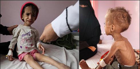  13 لاکھ یمنی بچے غذائی قلت کا شکار ،اسپتالوں میں دوائیں ختم