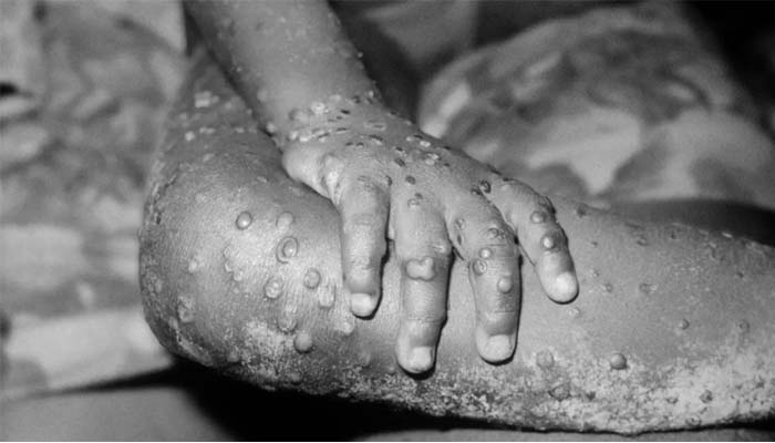 ویانا میں اتوار کی شب 35 سالہ شخص کو منکی پاکس کی مخصوص علامات کے ساتھ اسپتال لایا گیا/ فائل فوٹو