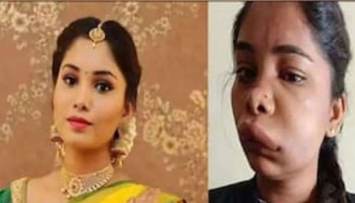 دانتوں کی غلط سرجری نے بھارتی اداکارہ سواتی ستیش کا چہرہ بگاڑ دیا۔— فوٹو: بھارتی میڈیا