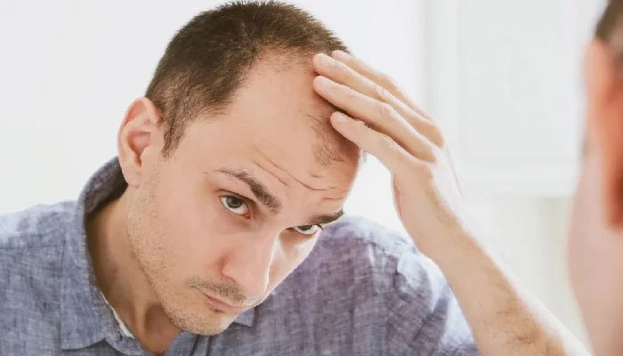 کسی بھی عمر یں بالوں کے گرنے یا گنج پن کا سامنا ہوسکتا ہے / فائل فوٹو