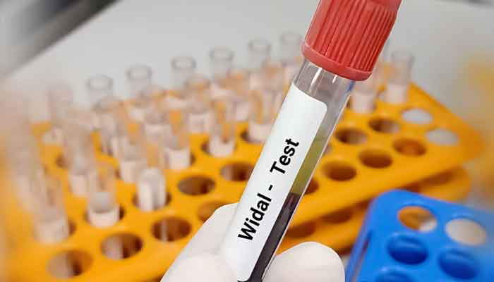 ٹائیفائیڈ بخار کی تصدیق کے لیے مصدقہ ٹیسٹ صرف بلڈ کلچر ہے اور وہی کیا جائے: قومی ادارہ برائے صحت۔ فوٹو فائل
