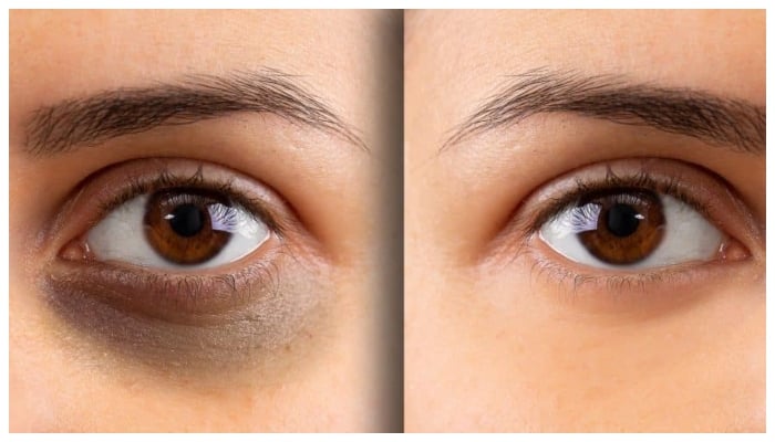 آنکھوں کے نیچے سیاہ حلقے ہونے کی وجوہات مختلف ہیں، جن میں جینیات، صحت، عمر اور طرز زندگی شامل ہے/ فائل فوٹو