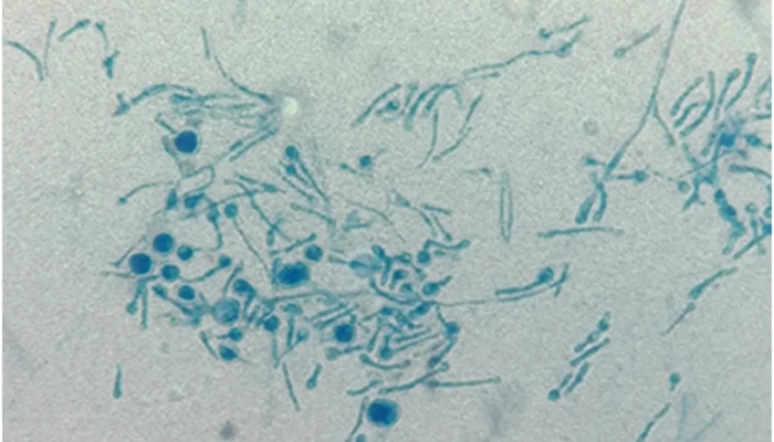 یہ بیماری صرف درختوں میں ہی نظر آتی ہے / فوٹو بشکریہ Medical Mycology Case Reports