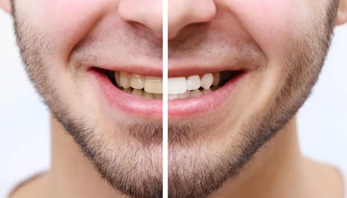 چند غذاؤں کے استعمال سے دانتوں کی سفیدی کو بحال کرنا ممکن ہے / فائل فوٹو