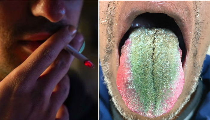 سگریٹ نوشی کا زیادہ استعمال امریکی شہری کی زبان کی رنگت اور ساخت میں تبدیلی کا باعث بنا/ فوٹو سوشل میڈیا