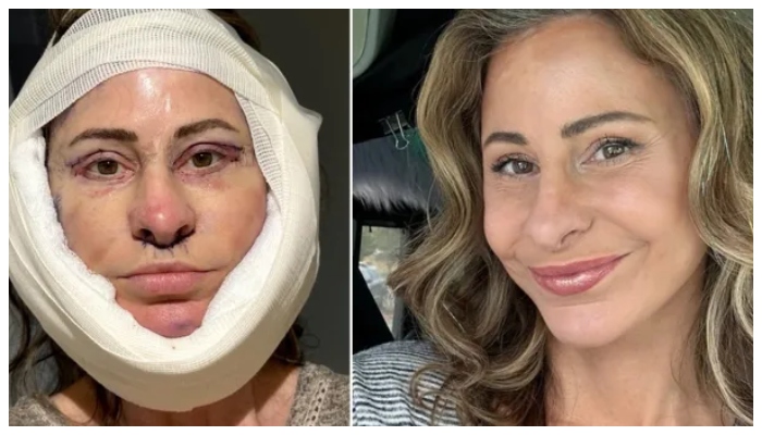 چہرے کی کاسمیٹک سرجری کے لیے مجموعی طور پر 14,000ڈالرز کی لاگت آئی__فوٹو: فائل
