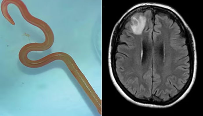 اس کیڑے کو سرجری کے ذریعے مریضہ کے دماغ سے نکالا گیا / فوٹو بشکریہ کینبرا ہیلتھ