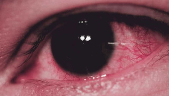 اسپتالوں میں آشوب چشم کے یومیہ سیکڑوں مریض آرہے ہیں جس سے بچاؤ انتہائی آسان ہے: ماہرین/ فائل فوٹو