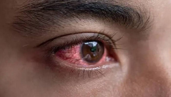 آنکھوں کے انفیکشن سے بچنے کیلئے ماہرین امراض چشم نے احتیاطی تدابیر اختیار کرنے کی ہدایت کی ہیں/ فائل فوٹو