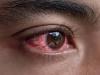 آشوب چشم کی وبا موسم کی تبدیلی تک برقرار رہے گی: ماہر امراض چشم