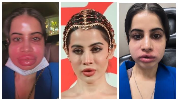 لِپ فلرز  سرجری، عرفی جاوید کی نئی چونکا دینے والی ویڈیو سامنے آگئی