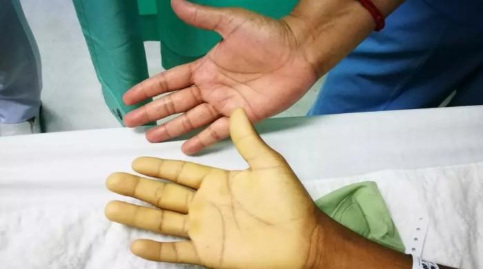 آئرن کی کمی سے لاحق ہونے والے انیمیا کی عام نشانیاں
