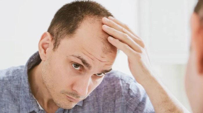 ماہرین کی گنج پن کے علاج کے حوالے سے حوصلہ افزا پیشرفت