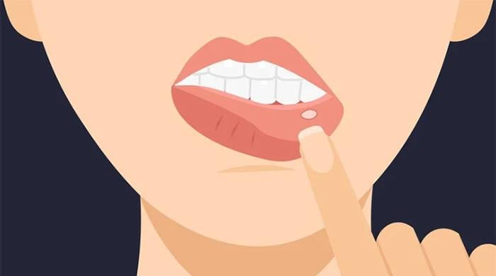 آپ کو اکثر منہ کے چھالوں کا سامنا کیوں ہوتا ہے؟