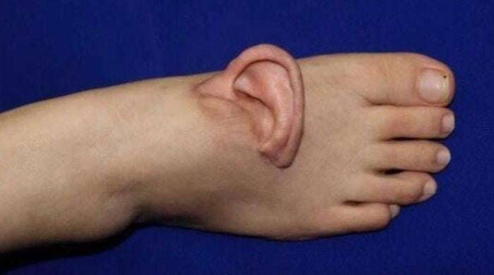 مشین میں بال الجھنے سے چینی خاتون کا کان کٹ گیا، ڈاکٹرز نے کان پیر میں کیوں لگایا؟