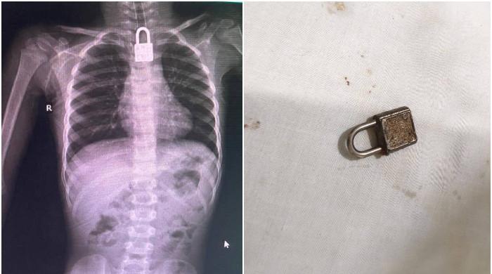 فیصل آباد: نجی اسپتال میں کامیاب آپریشن، 3 سالہ بچےکےگلے میں پھنسا تالا نکال لیا گیا