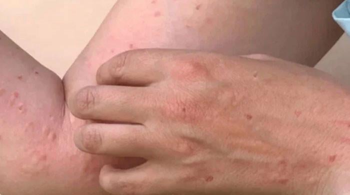 کراچی میں منکی پاکس کا دوسرا کیس رپورٹ