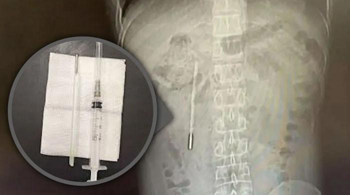 ڈاکٹرز نے چینی شہری کے پیٹ سے بچپن میں نگلا ہوا تھرمامیٹر کئی سال بعد نکال لیا