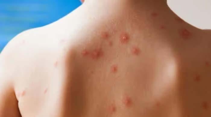 ملک بھر میں خسرے سے 71 اموات رپورٹ