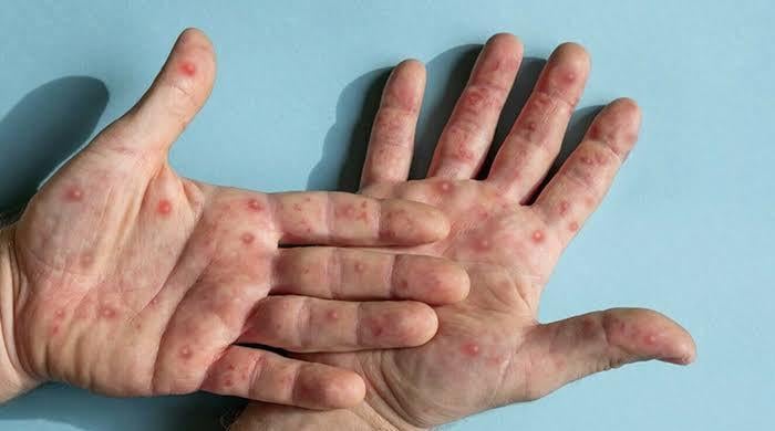  نواب شاہ کے رہائشی 50 سالہ مریض میں منکی پاکس کی تصدیق